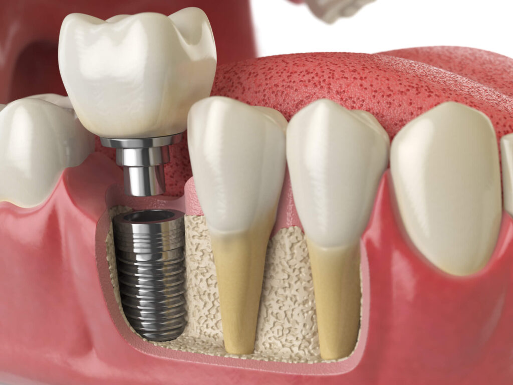 3D illustration of dental implant in Miami, FL
