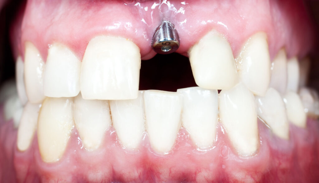titanium post of a dental implant in Miami, FL