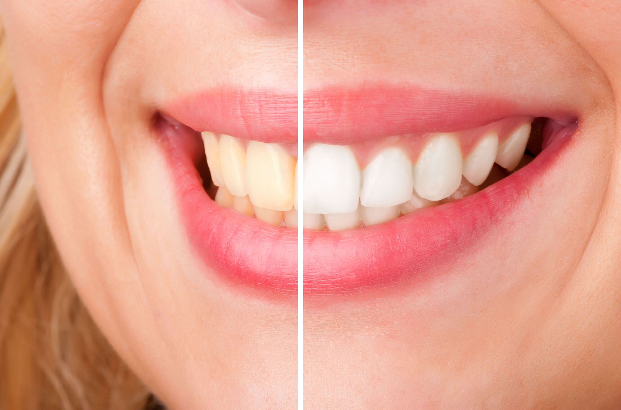 Close up of a smile before and after teeth whitening in Miami
