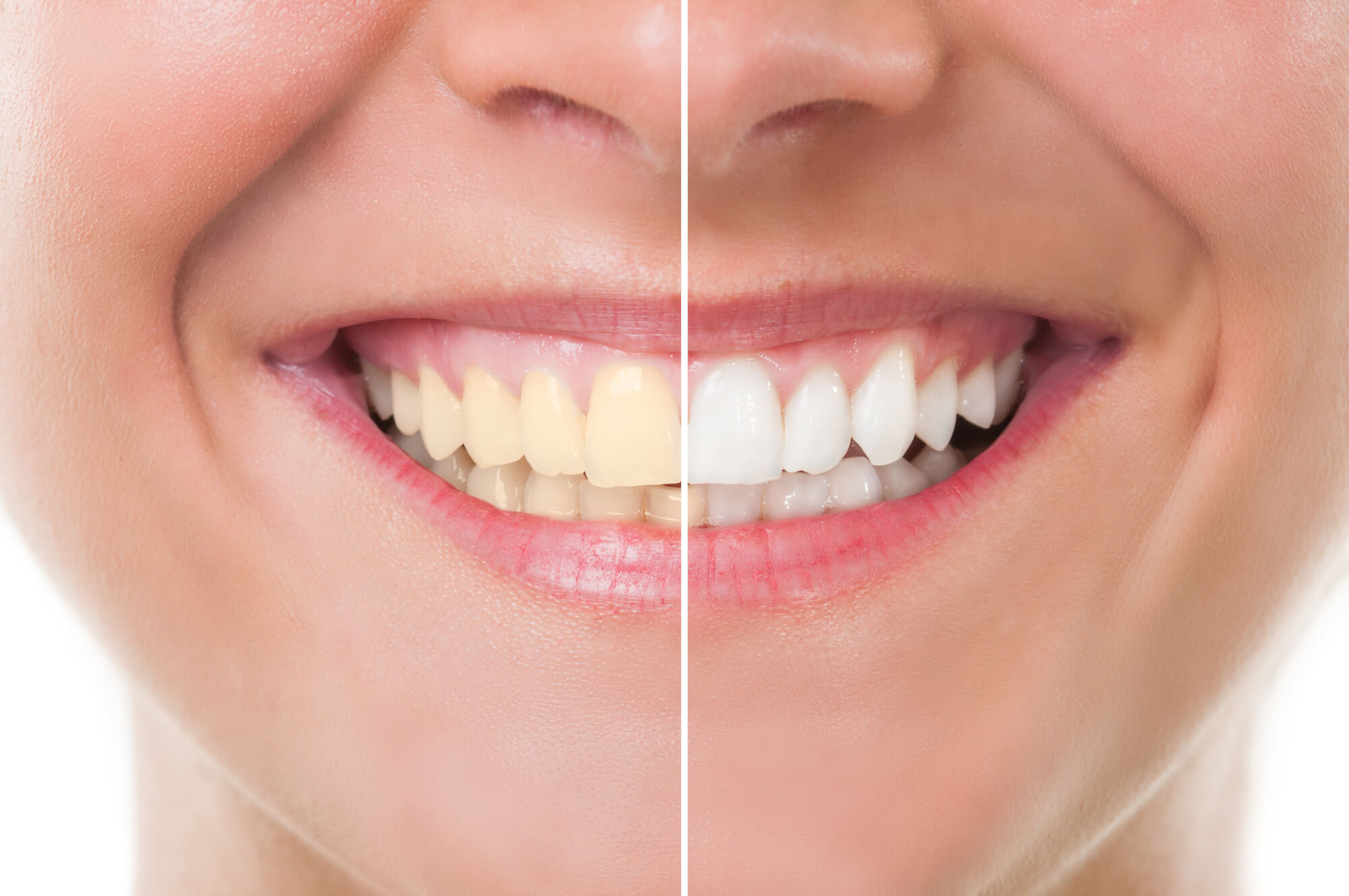 before and after teeth whitening in Miami