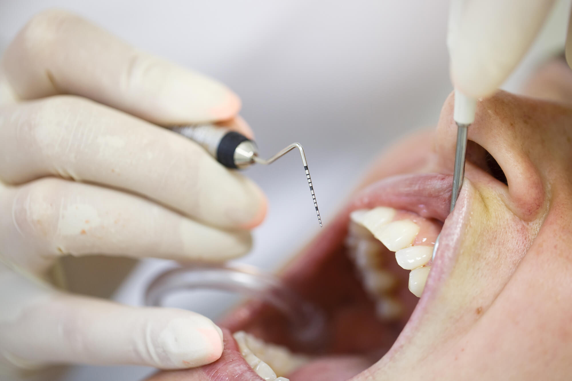 close up dentist during periodontics in Miami treatment