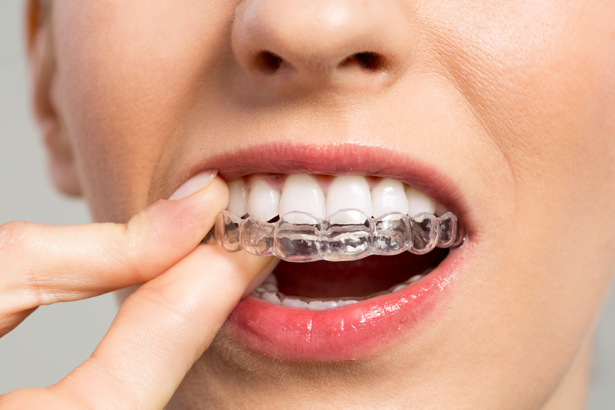 woman about to put her clear aligners as instructed by miami orthodontic specialists