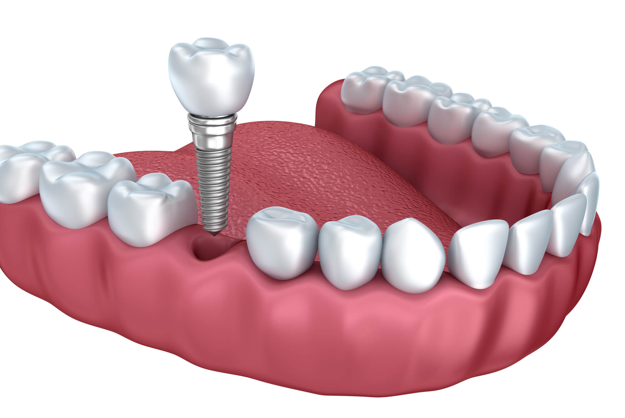 dental implant in Miami illustration